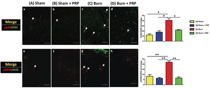 , Platelet-Rich Plasma Injection in Burn Scar Areas Alleviates Neuropathic Scar Pain
