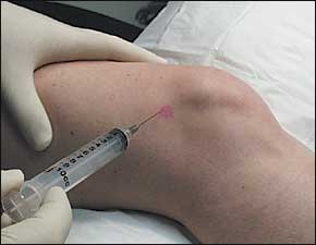 Exosomes Treatment, Regenerative Medicine For Knees Pain